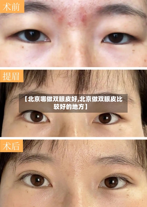 【北京哪做双眼皮好,北京做双眼皮比较好的地方】-第2张图片