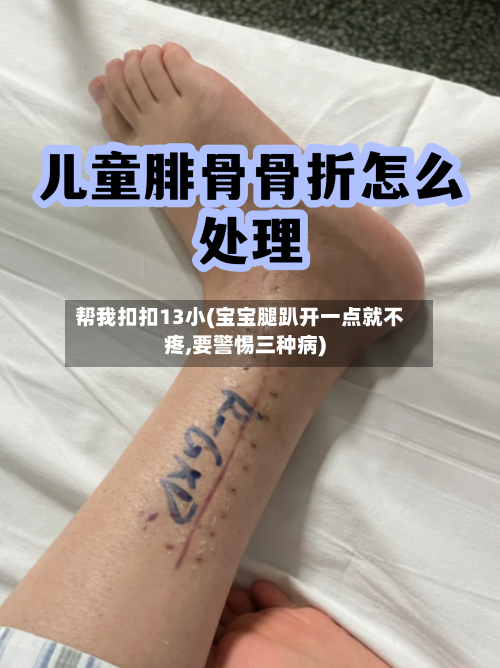 帮我扣扣13小(宝宝腿趴开一点就不疼,要警惕三种病)-第3张图片